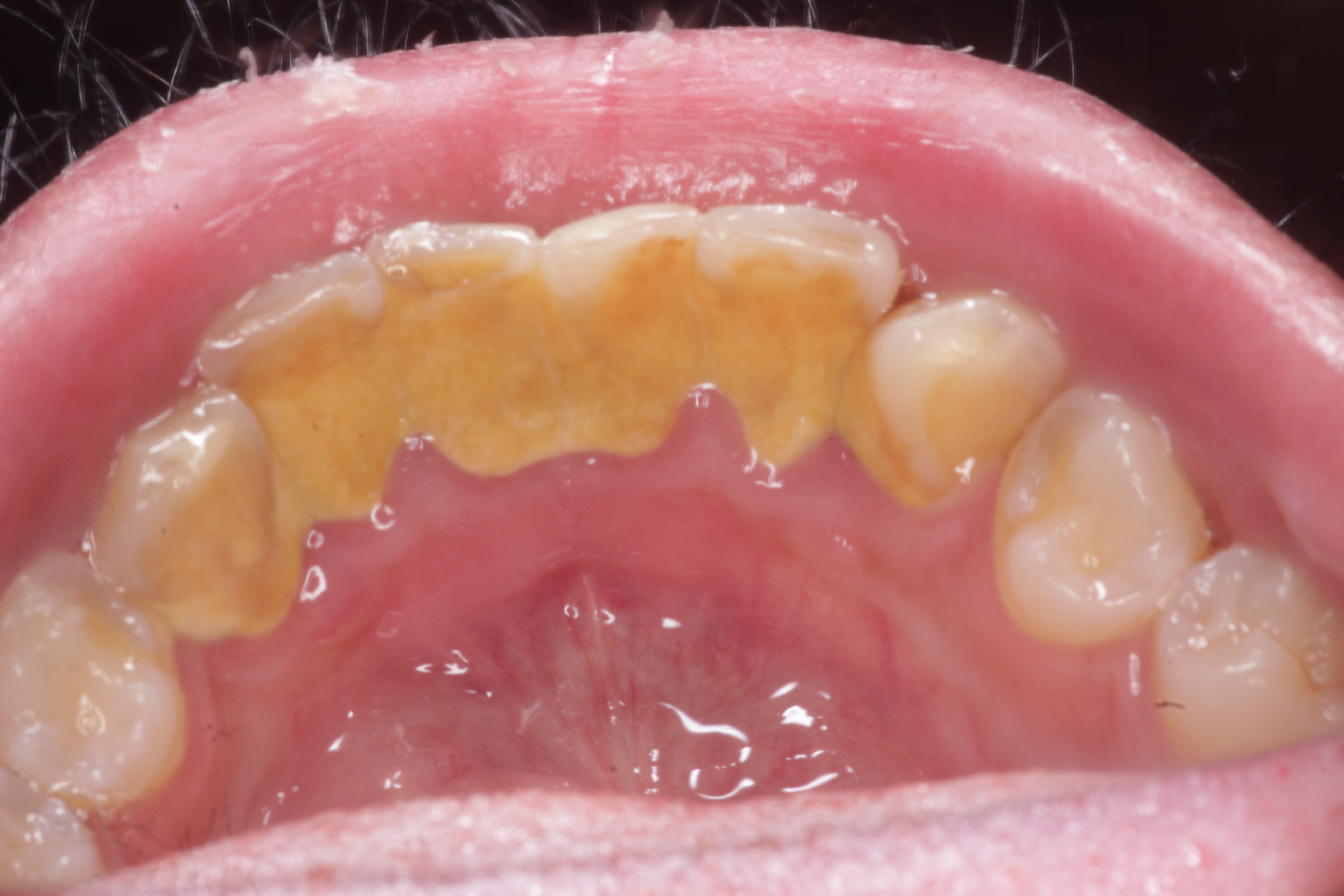 Teeth Before Cleaning